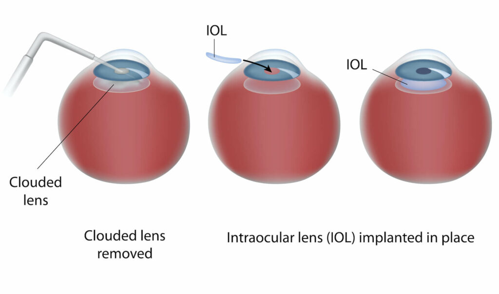 Diagram of cataract surgery