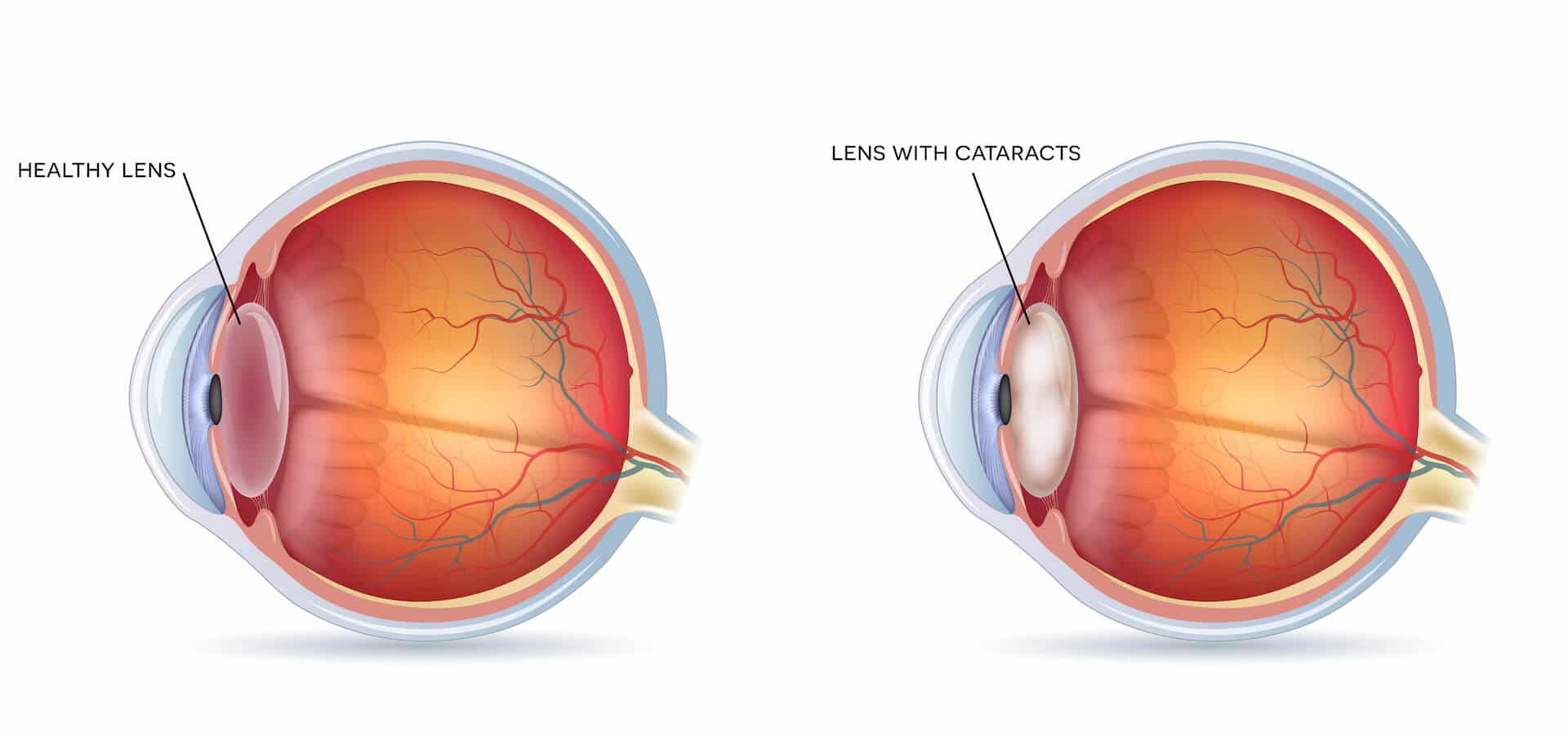 Cataracts and healthy eye detailed structure.