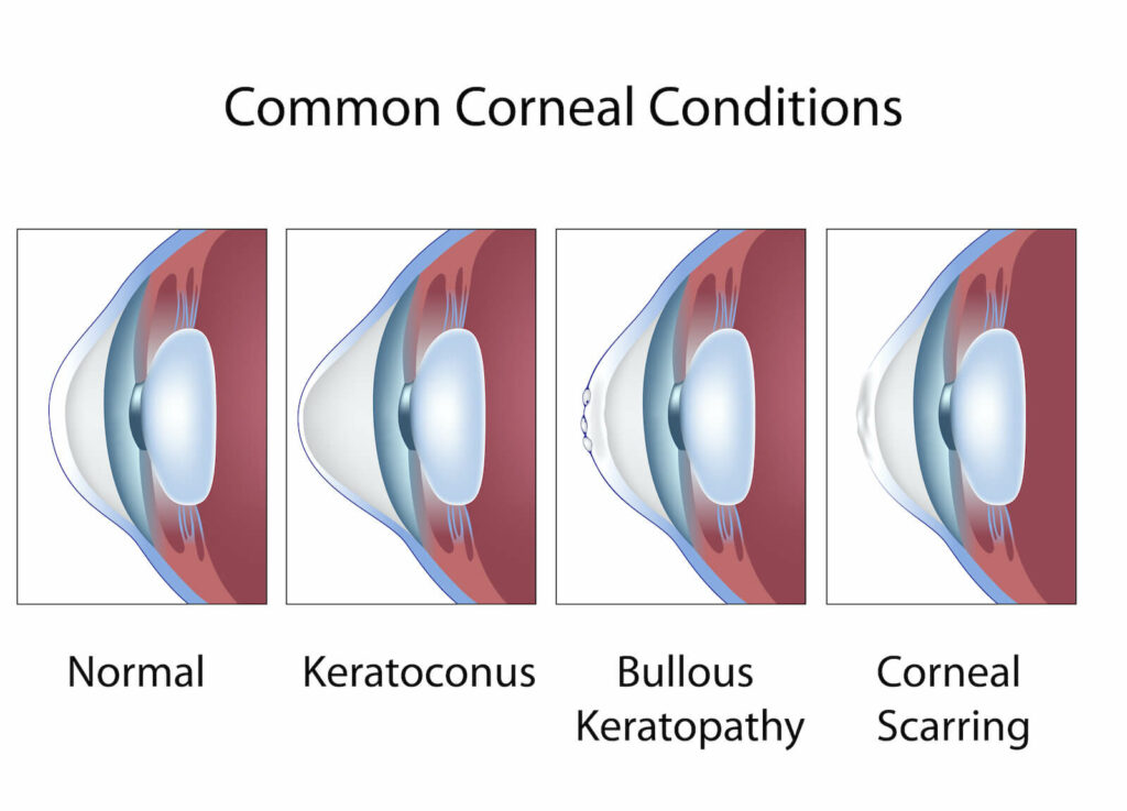 Common corneal conditions, eye cornea diseases