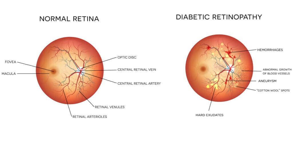 Diagram of diabetic retinopathy