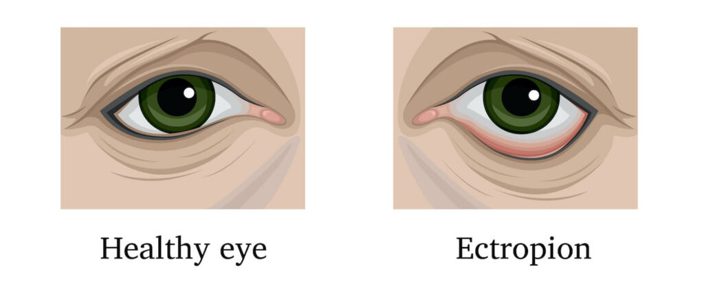 Diagram of ectropion, drooping eyelid
