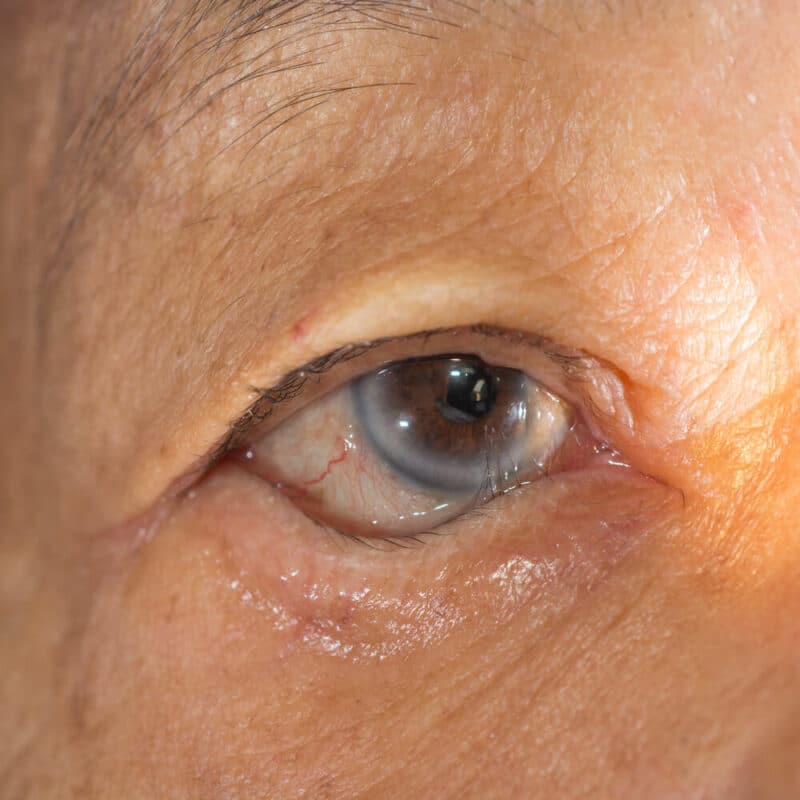Close up of the aging eye with entropion
