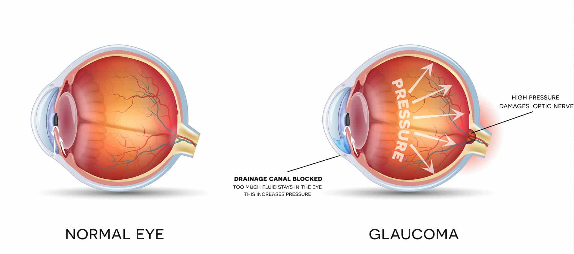 Diagram of glaucoma