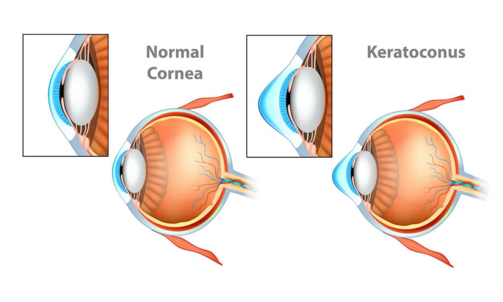 Normal Cornea and Keratoconus (KC) Cornea.