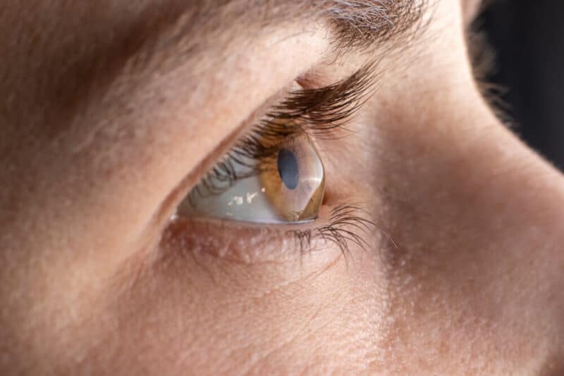 Closeup of a brown eye with a rounded cornea showing Keratoconus