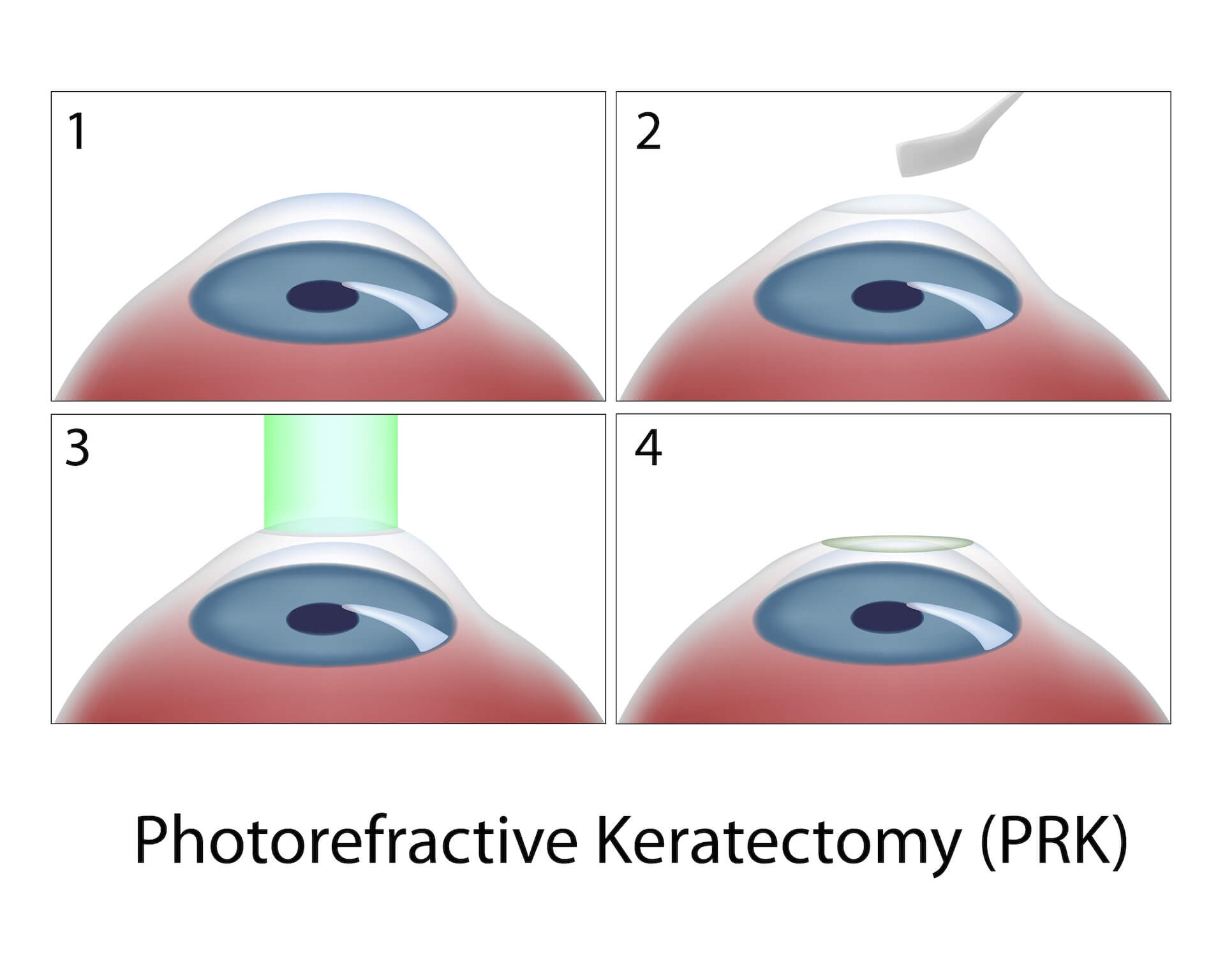 Diagram showing the steps of Photorefractive Keratectomy (PRK) surgery