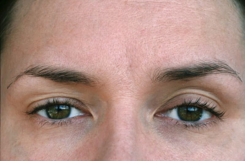 Closeup of woman's eyes. One has ptosis.